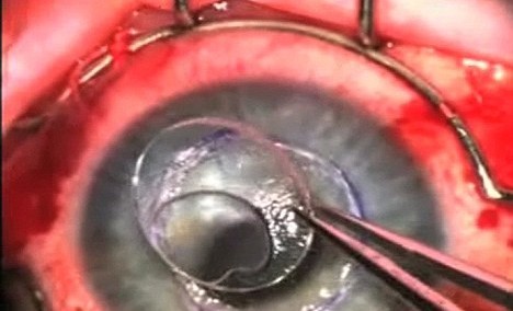 加拿大科学家成功制成人工眼角膜
